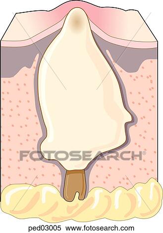 Cross-section of hair follicle and sebaceous gland of the skin showing an inflamed pustule, a pimple; follicle is blocked, sebum has filled and expanded follicle cavity. View Large Illustration Stock Illustration - Cross-section of hair follicle and sebaceous gland of the skin showing an inflamed pustule, a pimple; follicle is blocked, sebum has filled and expanded follicle cavity.. Fotosearch