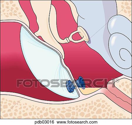 Cross-section of middle ear with drainage tube in place through tympanic membrane. View Large Illustration Stock Illustration - Cross-section of middle ear with drainage tube in place through tympanic membrane.. Fotosearch