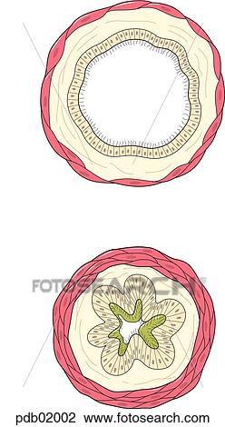 Cross-section of normal (above) and contracted bronchi. View Large Illustration Drawing - Cross-section of normal (above) and contracted bronchi.. Fotosearch