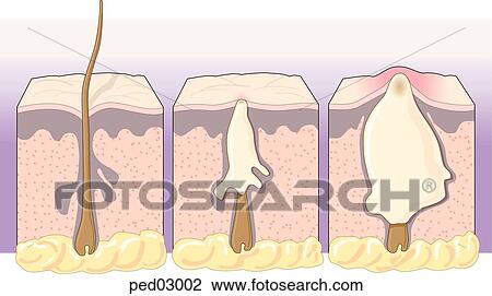 Cross-section of sebaceous gland of the skin showing three stages in the development of acne. View Large Illustration Drawing - Cross-section of sebaceous gland of the skin showing three stages in the development of acne.. Fotosearch