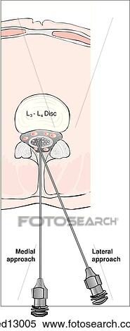 Cross-section of thorax at L3-L4 disc showing relevant lumbar anatomy; two spinal needles illustrate the medial and lateral approaches into the subarachnoid space where the cerebrospinal fluid is located. View Large Illustration Stock Illustration - Cross-section of thorax at L3-L4 disc showing relevant lumbar anatomy; two spinal needles illustrate the medial and lateral approaches into the subarachnoid space where the cerebrospinal fluid is located.. Fotosearch