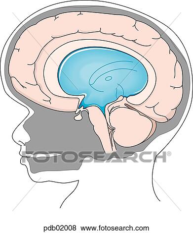 Stock Illustration - Cross-section view of child's skull showing brain displaced by fluid accumulation.. Fotosearch