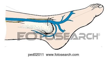 Dashed line on dorsal area of foot indicating location of incision for greater saphenous vein cutdown; vein and tibia bone are made visible within outline of foot. View Large Illustration Clip Art - Dashed line on dorsal area of foot indicating location of incision for greater saphenous vein cutdown; vein and tibia bone are made visible within outline of foot.. Fotosearch