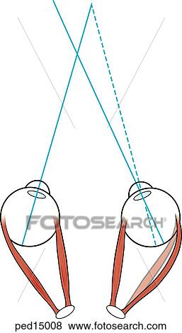 Stock Illustration - Diagram of the condition of strabismus, where one eye cannot focus with the other; view of eyeballs and their musculature from above with lines of vision indicated; note that right eye has an elongated muscle which does not allow it to turn the eyeball fa. Fotosearch