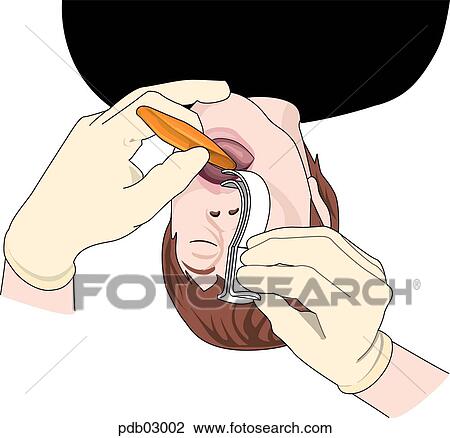 Drawing - Drawing demonstrating insertion of oropharyngeal airway.. Fotosearch