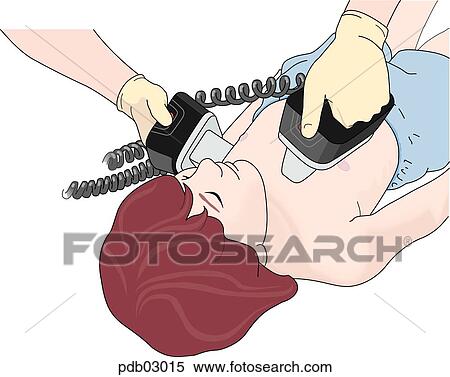 Drawing demonstrating position of paddles for defibrillating child. View Large Illustration Stock Illustration - Drawing demonstrating position of paddles for defibrillating child.. Fotosearch