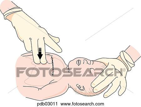 Clip Art - Drawing demonstrating pressing on child's chest with two fingers.. Fotosearch