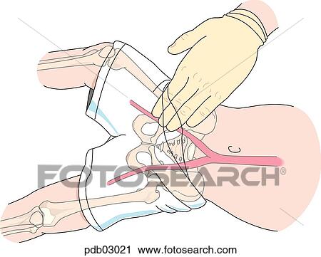 Clip Art - Drawing demonstrating taking a femoral pulse in a child.. Fotosearch
