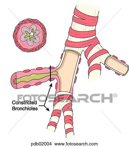 Drawing of bronchus showing constricted bronchioles; cross-section of bronchiole. View Large Illustration Stock Illustration - Drawing of bronchus showing constricted bronchioles; cross-section of bronchiole.. Fotosearch