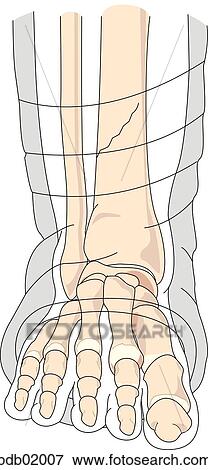 Drawing of foot and lower leg in cast with bones indicated and tibia fractured just above ankle. View Large Illustration Stock Illustration - Drawing of foot and lower leg in cast with bones indicated and tibia fractured just above ankle.. Fotosearch