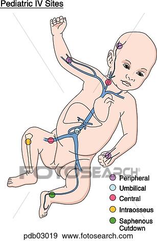Stock Illustration - Drawing of infant showing various sites for IV insertion.. Fotosearch