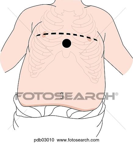 Clipart - Drawing of infant torso demonstrating CPR compression site.. Fotosearch