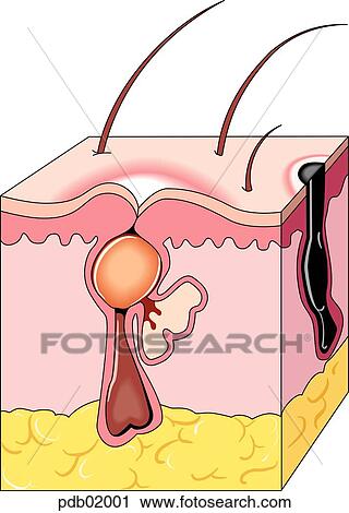 Clip Art - Drawing of skin section showing pustular eruption.. Fotosearch