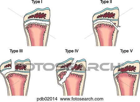 Drawings demonstrating the five types of bone fracture in the Salter classification. View Large Illustration Stock Illustration - Drawings demonstrating the five types of bone fracture in the Salter classification.. Fotosearch