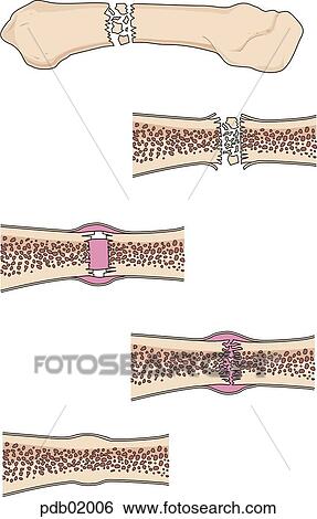 Drawings showing stages of bone fracture healing. View Large Illustration Stock Illustration - Drawings showing stages of bone fracture healing.. Fotosearch