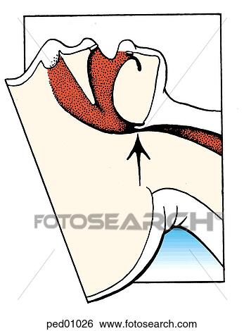 Stock Illustration - Extreme hyperextension of head/neck causing upper airway obstruction in an infant.. Fotosearch
