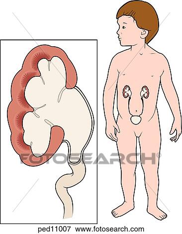 Stock Illustration - Frontal section of affected kidney and ureter (left); child standing with kidneys and bladder visible (right); note hydronephrosis of right kidney.. Fotosearch