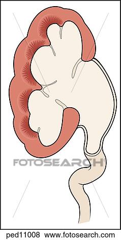 Frontal section of affected kidney and ureter as seen in hydronephrosis. View Large Illustration Stock Illustration - Frontal section of affected kidney and ureter as seen in hydronephrosis.. Fotosearch