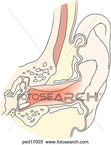 Drawing - Frontal section of head showing outer, middle, and inner ear anatomy in a child suffering from otitis media or swimmer's ear; note the swollen and inflammed walls of the canal as well as wax buildup.. Fotosearch