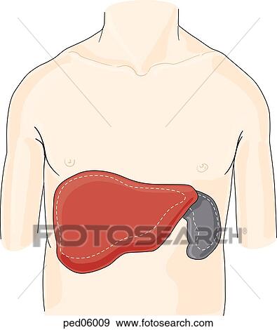 Frontal view of child's chest and abdomen with liver and spleen shown in the enlarged state of hepatosplenomegaly; normal size of these organs indicated by dashed lines. View Large Illustration Stock Illustration - Frontal view of child's chest and abdomen with liver and spleen shown in the enlarged state of hepatosplenomegaly; normal size of these organs indicated by dashed lines.. Fotosearch