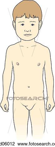 Drawing -  girl with an inguinal hernia, external appearance.. Fotosearch
