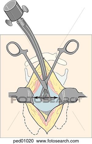 Clipart - Hemostats maintain the horizontal opening in the cricothyroid membrane while tracheal tube is passed through the incision and into the trachea; sternohyoid m. is retracted; position of thyroid gland is indicated.. Fotosearch