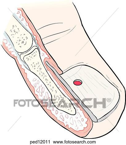 Hole in nail over hematoma after nail trephination. View Large Illustration Clip Art - Hole in nail over hematoma after nail trephination.. Fotosearch