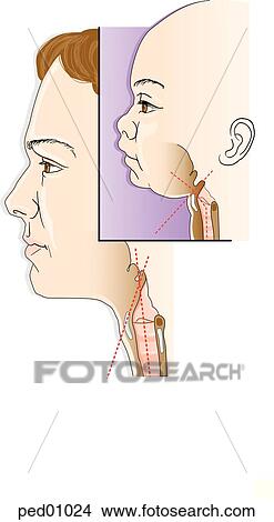 Stock Illustration - Illustration comparing infant and adult epiglottis; infant-the epiglottis has a greater angle relative to the axis of the trachea (dashed lines); adult-the epiglottis has a more parallel orientation; infant's vocal cords have a lower attachment anteriorl. Fotosearch