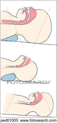 Illustration demonstrating correct and incorrect positioning of the neonatal airway; (top) correct position of head and neck resulting in slight neck extension; (middle) incorrect positioning resulting in overextension of neck; (bottom) incorrect po View Large Illustration Drawing - Illustration demonstrating correct and incorrect positioning of the neonatal airway; (top) correct position of head and neck resulting in slight neck extension; (middle) incorrect positioning resulting in overextension of neck; (bottom) incorrect po. Fotosearch