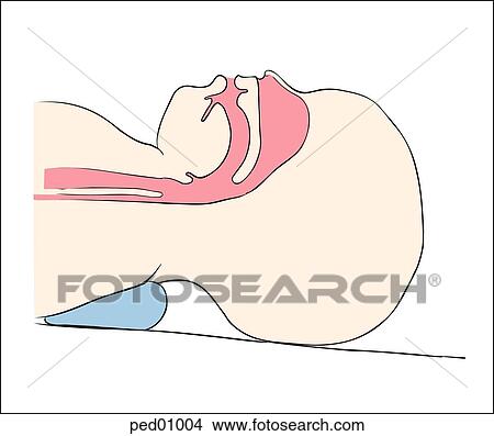 Stock Illustration - Illustration demonstrating correct positioning of the neonatal airway; child's airway is shown within head and neck, slight neck extension, slight Trendelenburg.. Fotosearch