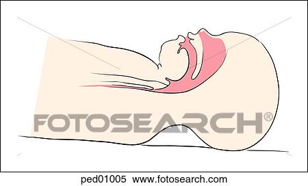 Stock Illustration - Illustration demonstrating incorrect positioning of the neonatal airway; child's airway is shown within head and neck; incorrect positioning results in inadequate extension.. Fotosearch