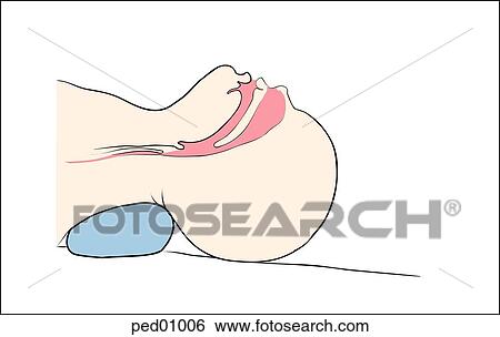 Stock Illustration - Illustration demonstrating incorrect positioning of the neonatal airway; child's airway is shown within head and neck; incorrect positioning results in overextension of neck.. Fotosearch