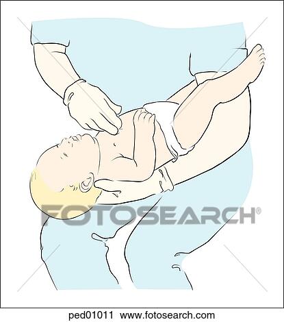 Clip Art - Illustration demonstrating proper administration of chest thrusts to relieve foreign body airway obstruction in the infant.. Fotosearch