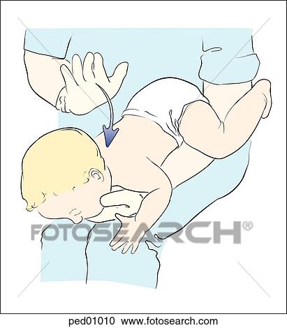 Illustration demonstrating proper administration of back blows to relieve foreign body obstruction in the infant. View Large Illustration Clipart - Illustration demonstrating proper administration of back blows to relieve foreign body obstruction in the infant.. Fotosearch