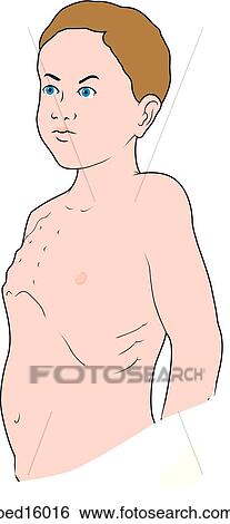 Stock Illustration - Illustration of a boy with pectus carinatum; note the protruding thoracic cage.. Fotosearch