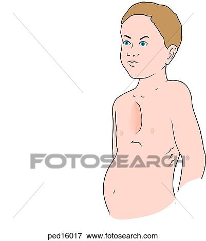 Illustration of a boy with pectus excavatum; note the sunken chest area. View Large Illustration Stock Illustration - Illustration of a boy with pectus excavatum; note the sunken chest area.. Fotosearch