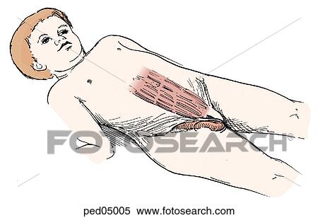 Stock Illustration - Illustration of child lying on back with an incarcerated inguinal hernia; some abdominal musculature is also visible.. Fotosearch