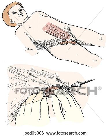 Stock Illustration - Illustration of child lying on back with an incarcerated inguinal hernia; some abdominal musculature is also visible; insert shows application of bimanual pressure on the incarcerated bowel in a direction to encourage reduction.. Fotosearch