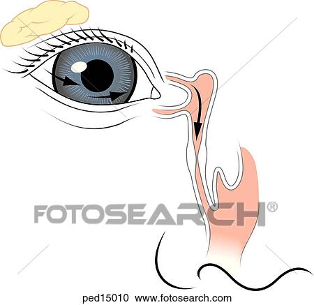 Clipart - Illustration of right eye and nose with anatomy of tearduct made visible; tearduct is blocked causing inflammation.. Fotosearch