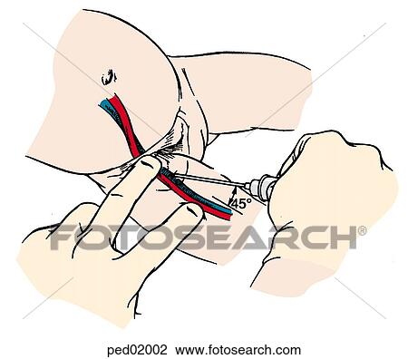 Illustration of technique commonly used to insert a catheter into the femoral vein. View Large Illustration Drawing - Illustration of technique commonly used to insert a catheter into the femoral vein.. Fotosearch