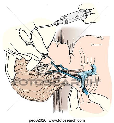 Clipart - Illustration of technique used in external jugular venipuncture; butterfly catheter is about to be inserted into external jugular vein of supine infant.. Fotosearch