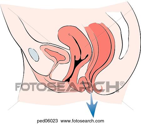 Drawing - Illustration of the anatomy of a partial rectal prolapse in a female child.. Fotosearch