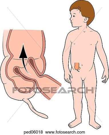 Illustration of the anatomy of ileocecal junction where intussusception has occurred; (left) a portion of the ileum has been pushed into the lumen of the adjoining cecum; (right) child is shown standing with location of ileocecal junction indicated. View Large Illustration Stock Illustration - Illustration of the anatomy of ileocecal junction where intussusception has occurred; (left) a portion of the ileum has been pushed into the lumen of the adjoining cecum; (right) child is shown standing with location of ileocecal junction indicated.. Fotosearch