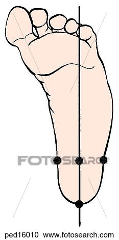 Illustration of the foot with metatarsus adductus deformity; note medial misalignment of foot. View Large Illustration Clipart - Illustration of the foot with metatarsus adductus deformity; note medial misalignment of foot.. Fotosearch