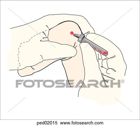 Stock Illustration - Illustration showing blood specimen being collected following heel puncture in safe area.. Fotosearch