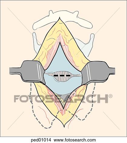 Illustration showing correct position of cricothyroid membrane incision (dashed line) for a surgical cricothyrotomy on a child; sternohyoid m. has been retracted. View Large Illustration Stock Illustration - Illustration showing correct position of cricothyroid membrane incision (dashed line) for a surgical cricothyrotomy on a child; sternohyoid m. has been retracted.. Fotosearch