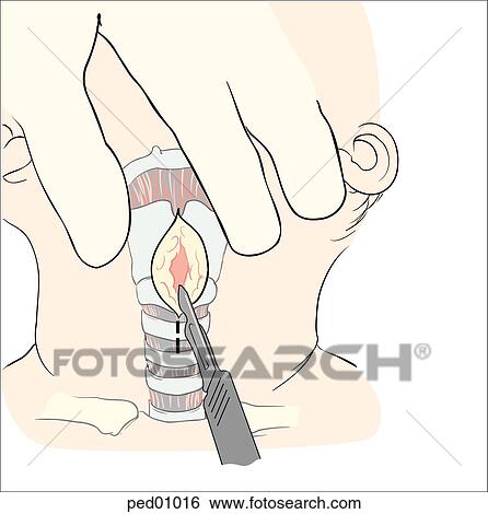 Illustration showing correct position of initial vertical incision (dashed line) for a surgical cricothyrotomy on a child; hand manually stabilizes trachea. View Large Illustration Stock Illustration - Illustration showing correct position of initial vertical incision (dashed line) for a surgical cricothyrotomy on a child; hand manually stabilizes trachea.. Fotosearch
