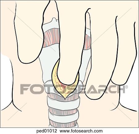 Drawing - Illustration showing cricothyroid membrane identification by palpation; finger is inserted into opening made by initial incision for a surgical cricothyrotomy.. Fotosearch