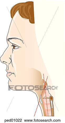 Illustration showing epiglottis of an adult; in an adult, the epiglottis has an almost parallel orientation relative to the axis of the trachea; adult's vocal cord attachments are perpendicular to trachea. View Large Illustration Drawing - Illustration showing epiglottis of an adult; in an adult, the epiglottis has an almost parallel orientation relative to the axis of the trachea; adult's vocal cord attachments are perpendicular to trachea.. Fotosearch