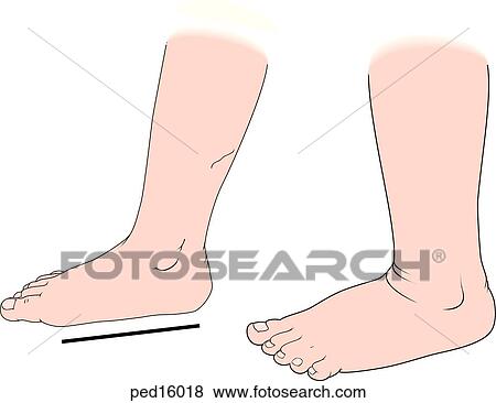 Stock Illustration - Illustration showing feet of child with pes planus or flat feet.. Fotosearch